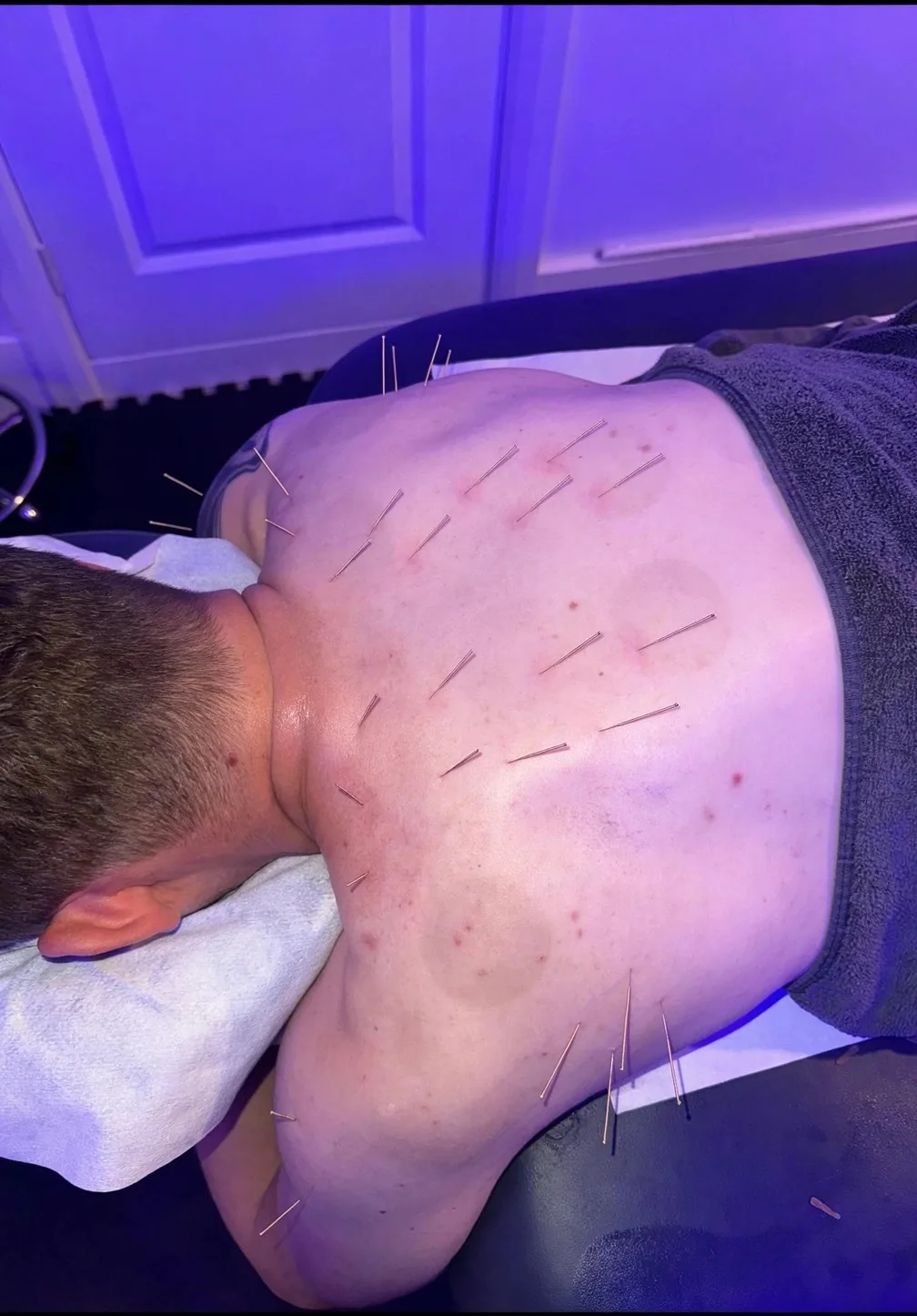 Needles placed across a client's upper back during treatment